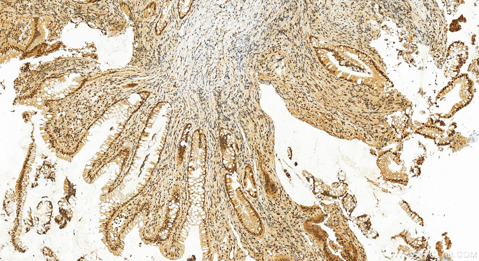 IHC staining of human colon  cancer using 11380-1-AP