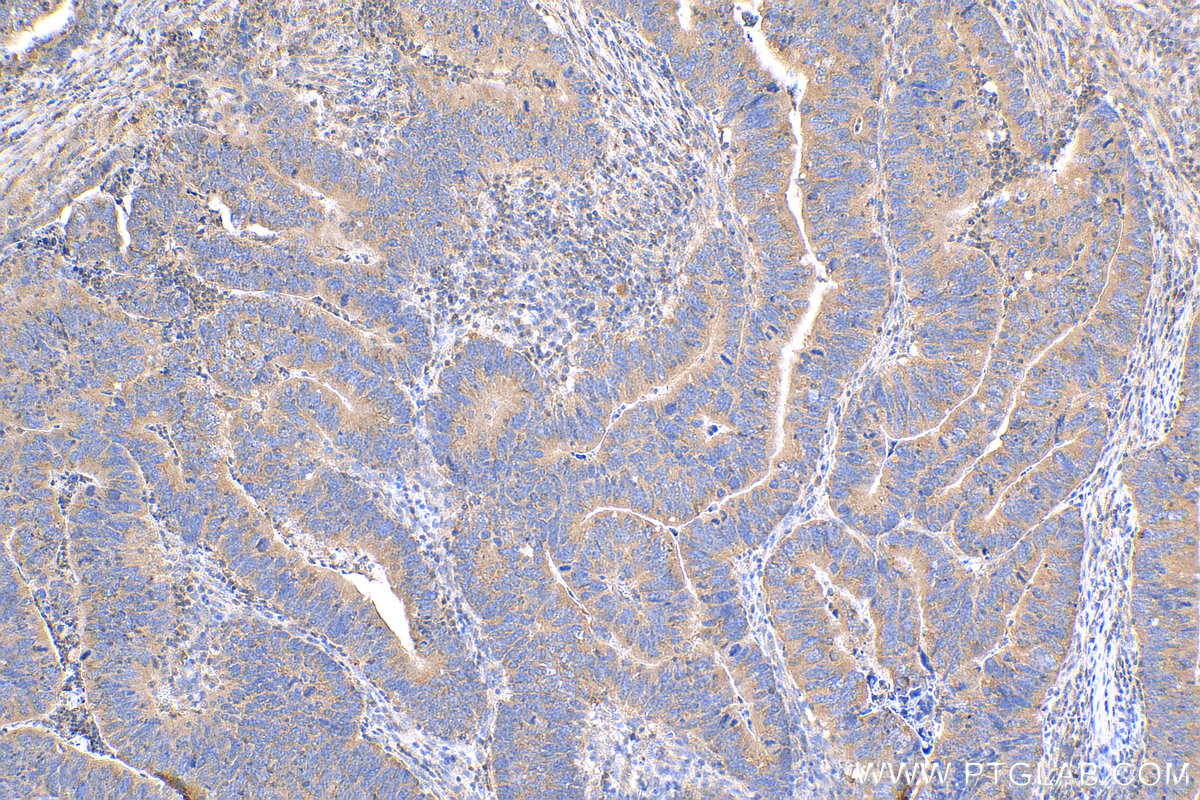 IHC staining of human colon cancer using 15204-1-AP