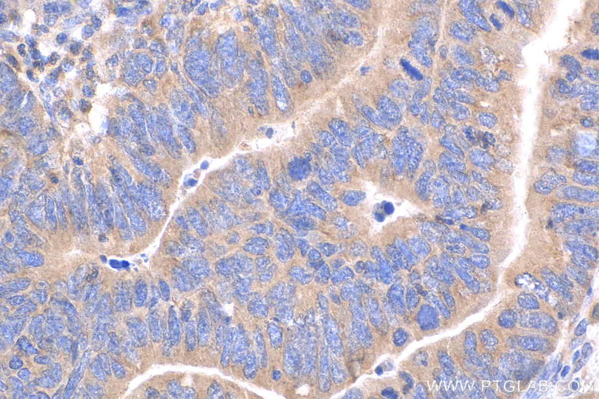 IHC staining of human colon cancer using 15204-1-AP