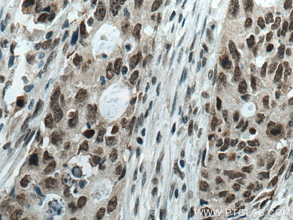 IHC staining of human colon cancer using 66925-1-Ig (same clone as 66925-1-PBS)