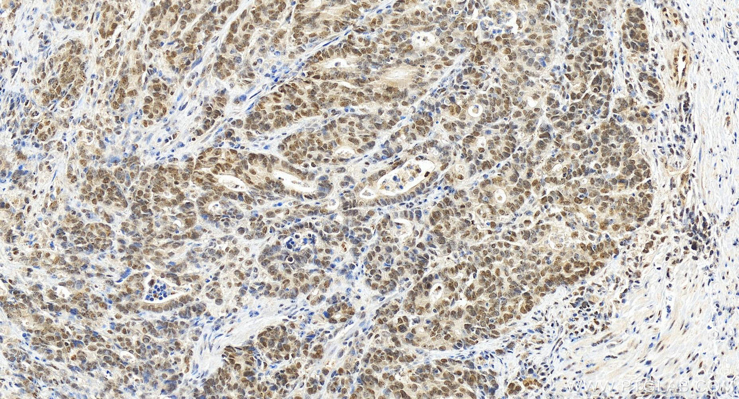 IHC staining of human stomach cancer using 15769-1-AP