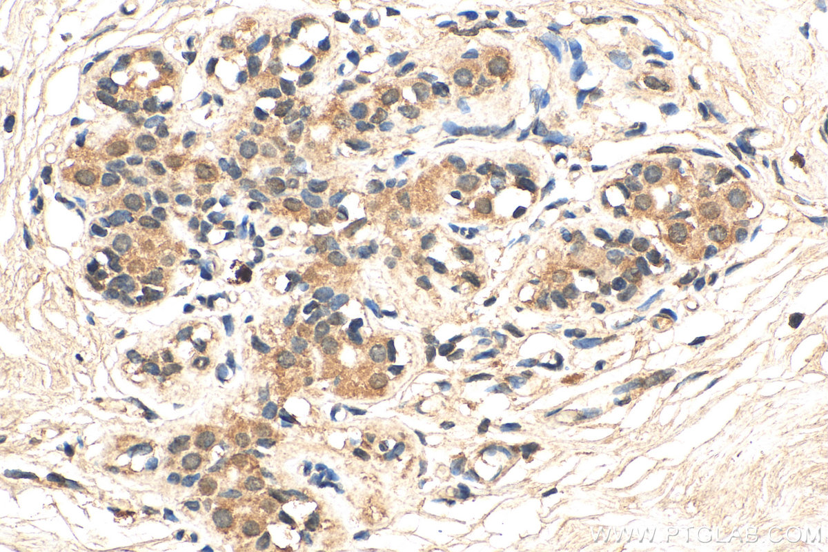 IHC staining of human breast cancer using 67915-1-Ig (same clone as 67915-1-PBS)