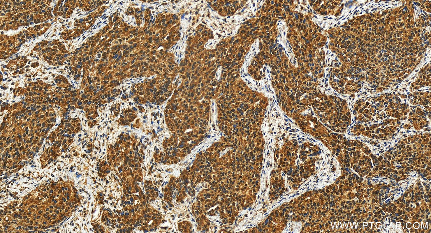 IHC staining of human ovary cancer using 27500-1-AP