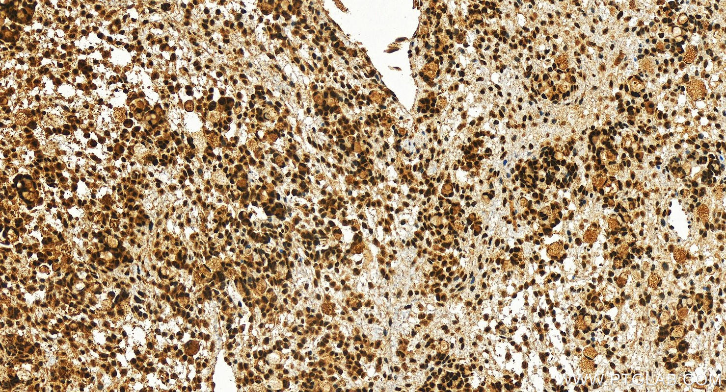 IHC staining of human ovary cancer using 16927-1-AP