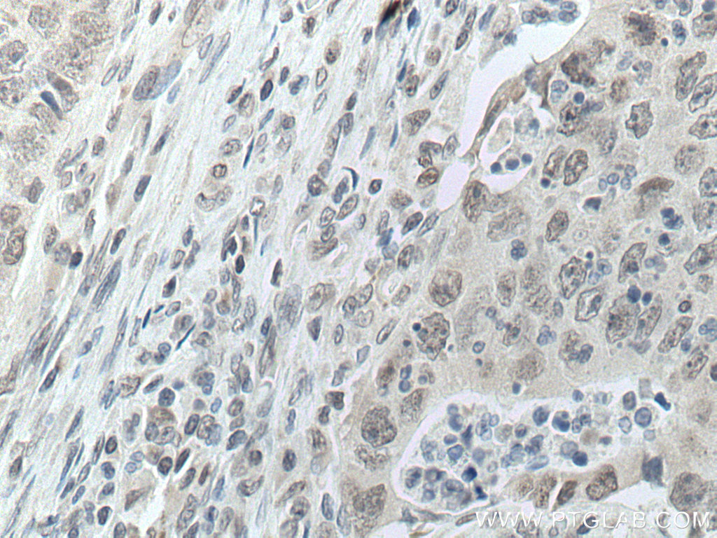IHC staining of human colon cancer using 67025-1-Ig (same clone as 67025-1-PBS)