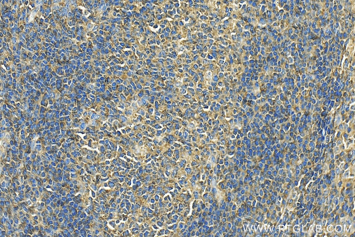 IHC staining of human tonsillitis using 11369-1-AP