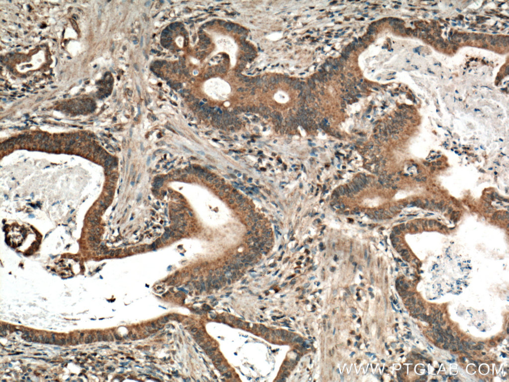 IHC staining of human stomach cancer using 25761-1-AP