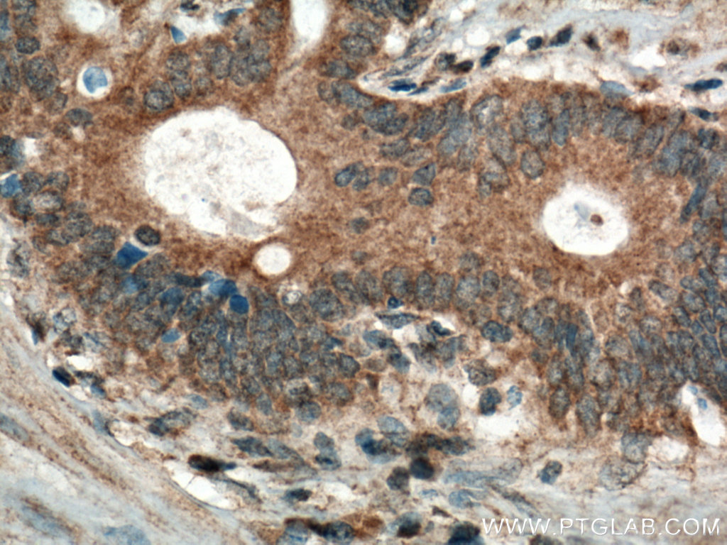 IHC staining of human stomach cancer using 25761-1-AP