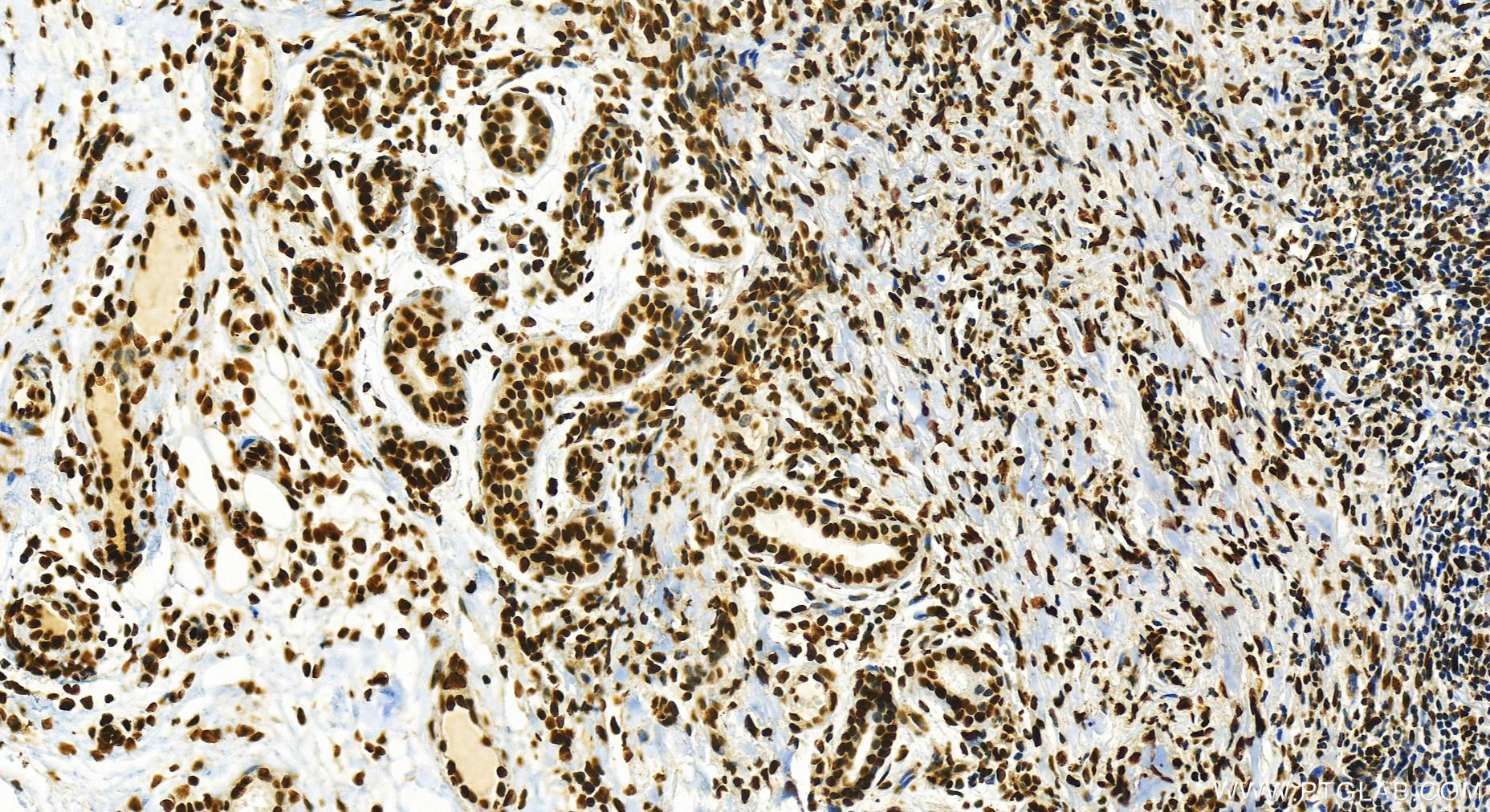 IHC staining of human skin cancer using 82880-1-RR (same clone as 82880-1-PBS)