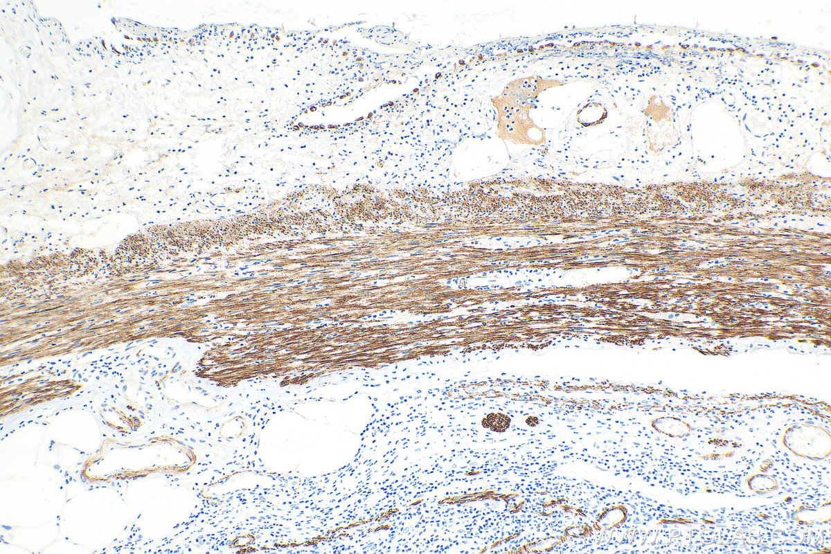 IHC staining of human appendicitis using 16520-1-AP