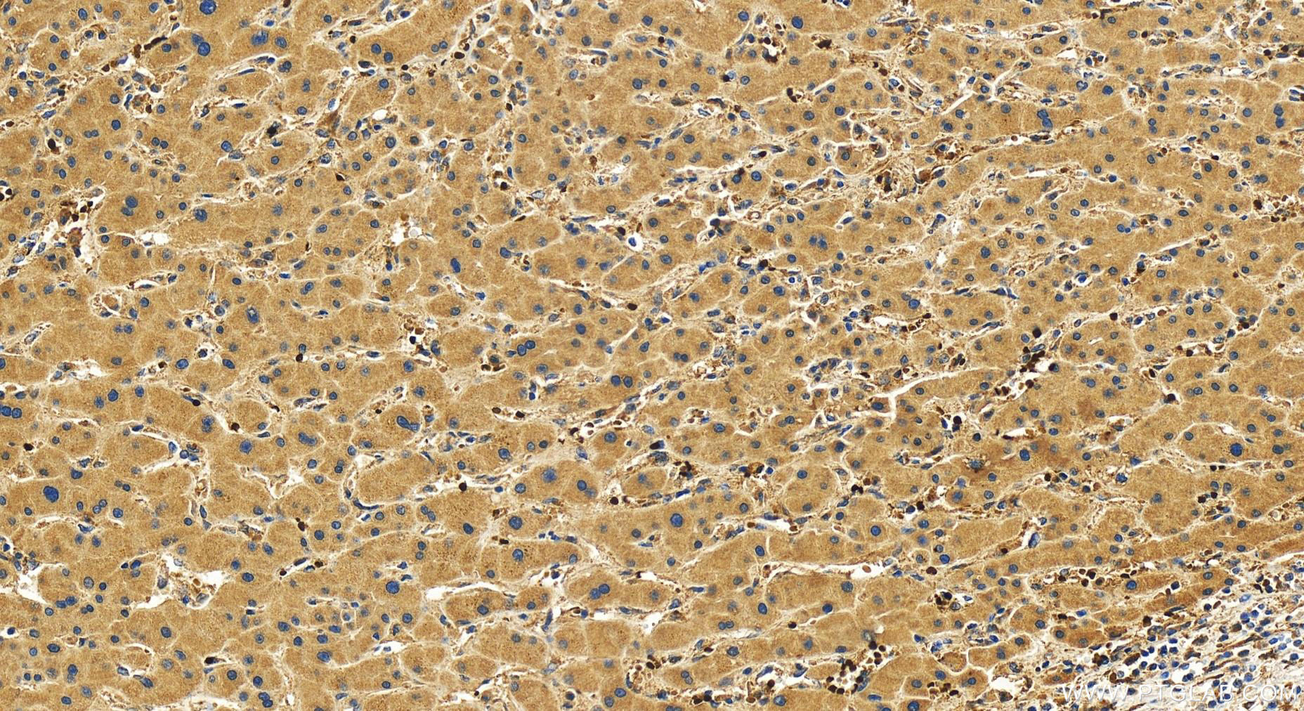 IHC staining of human intrahepatic cholangiocarcinoma using 31363-1-AP