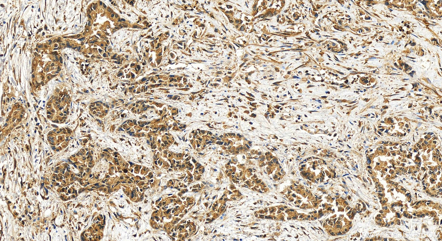 IHC staining of human intrahepatic cholangiocarcinoma using 31363-1-AP