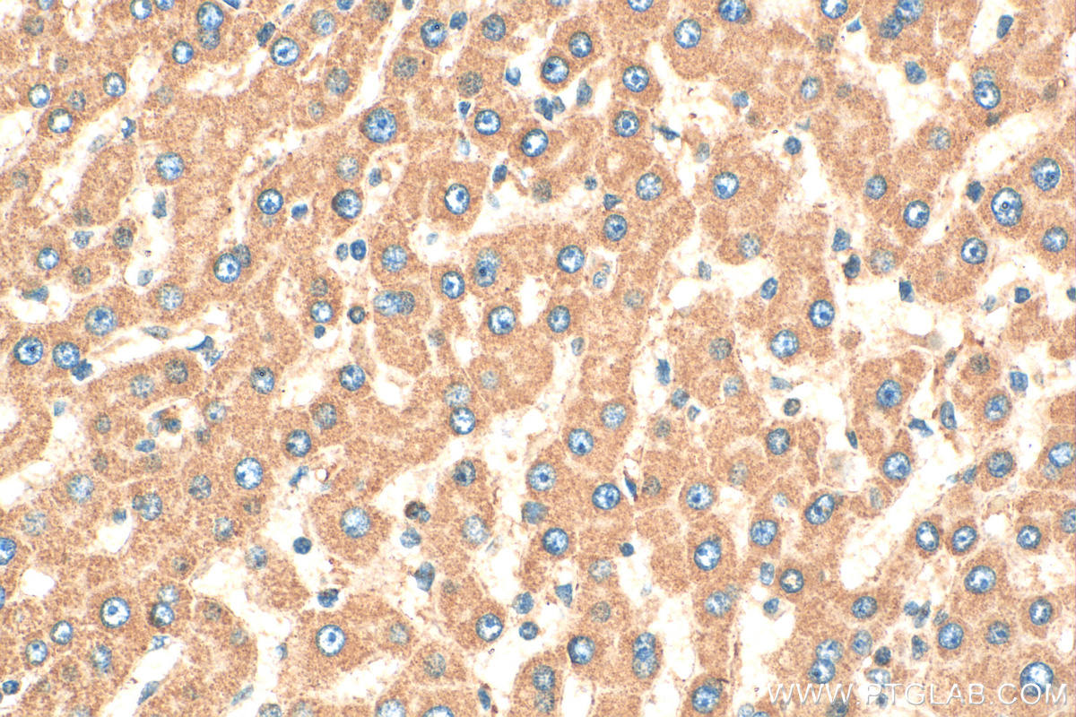 IHC staining of human hepatocirrhosis using 11561-1-AP