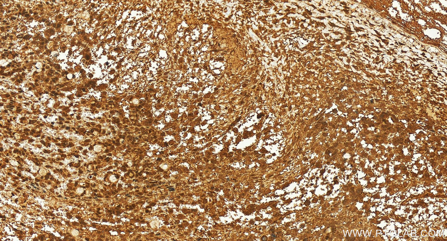 IHC staining of human ovary cancer using 25835-1-AP