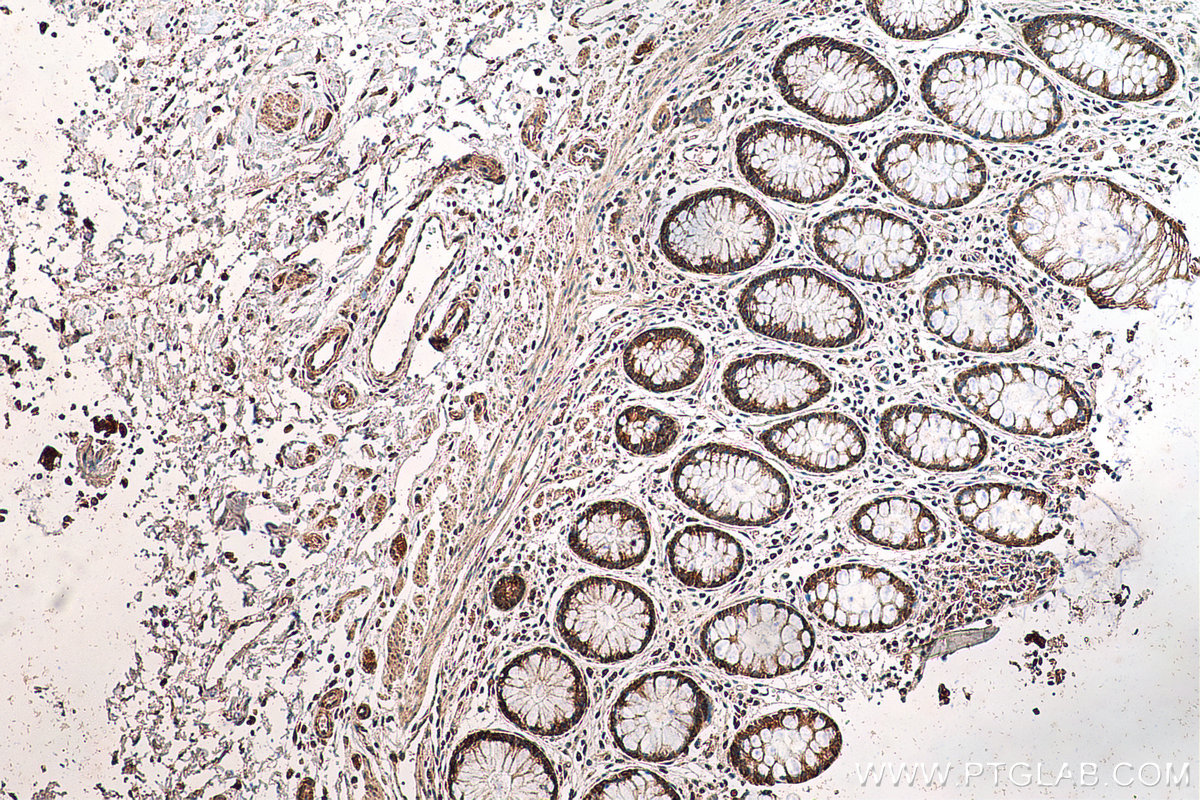 IHC staining of human colon cancer using 11900-1-AP