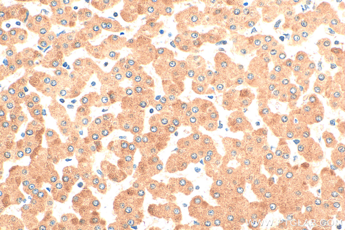 IHC staining of human hepatocirrhosis using 16314-1-AP