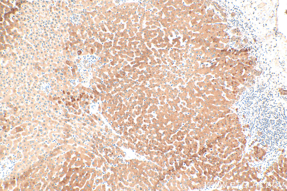 IHC staining of human hepatocirrhosis using 16314-1-AP