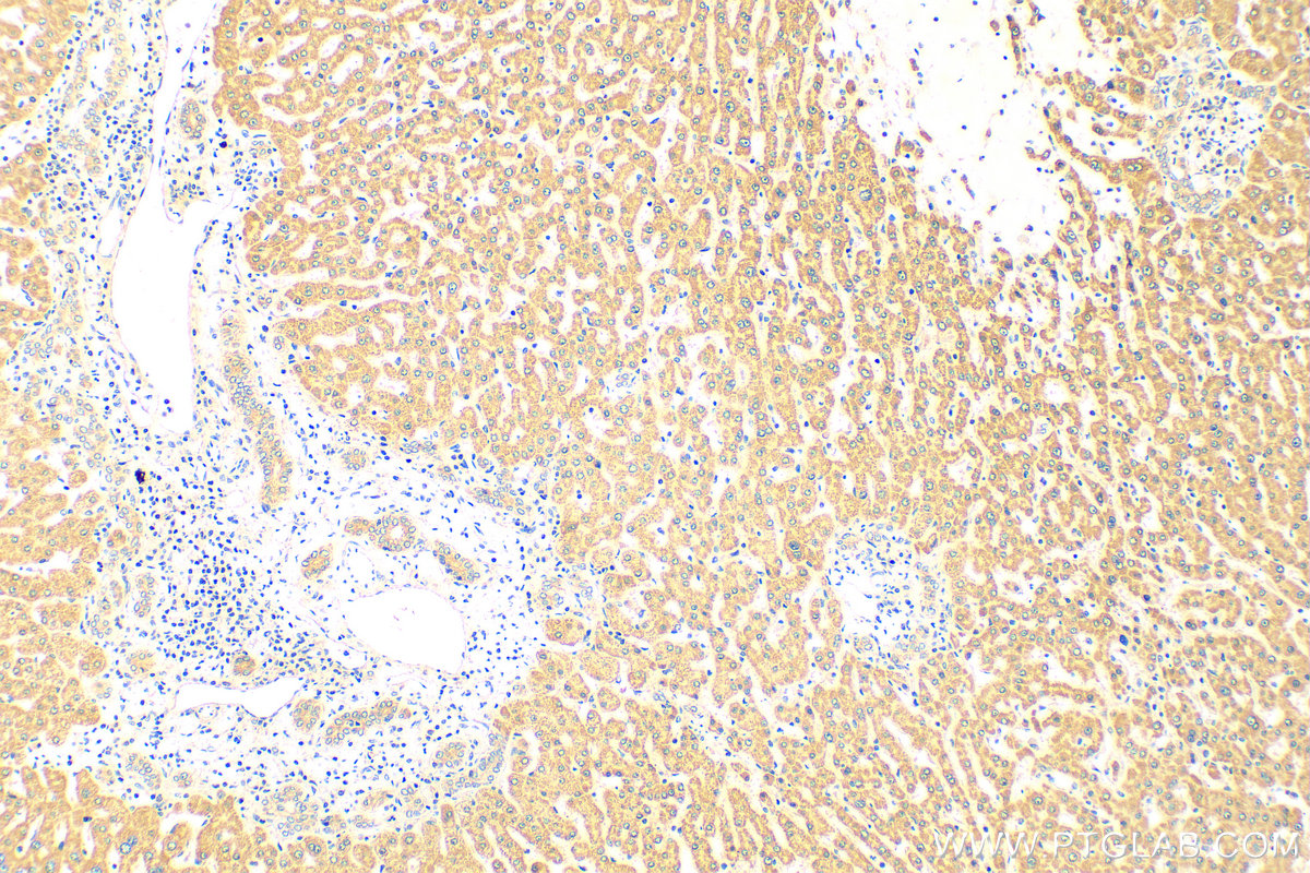 IHC staining of human hepatocirrhosis using 16314-1-AP