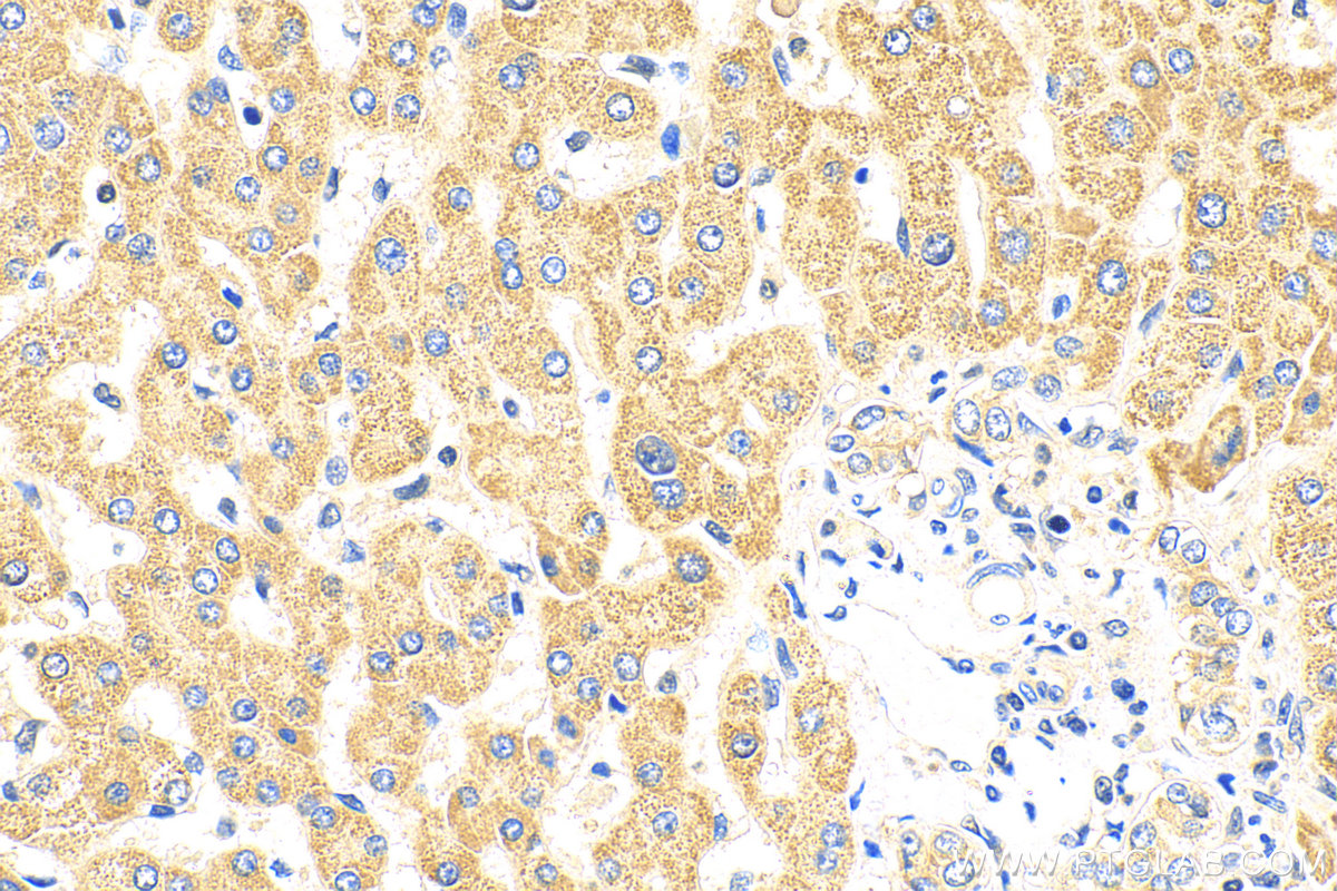 IHC staining of human hepatocirrhosis using 16314-1-AP