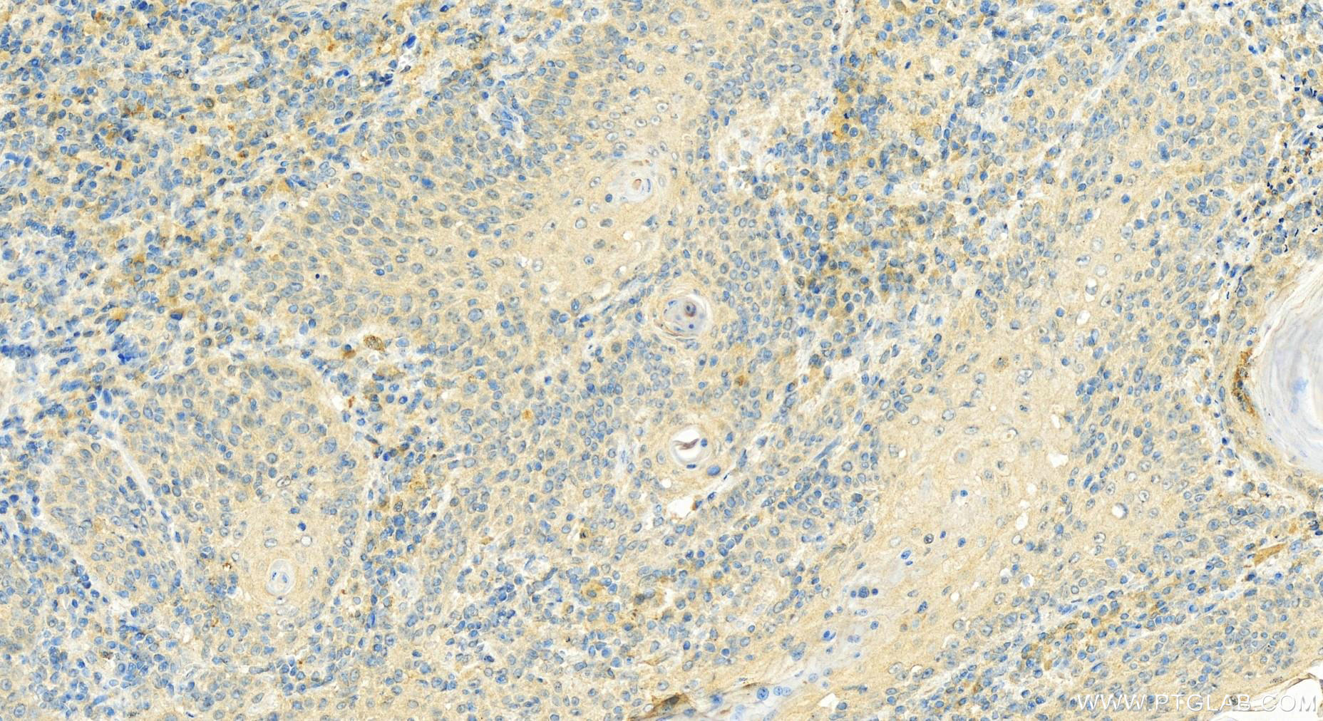 IHC staining of human skin cancer using 16459-1-AP