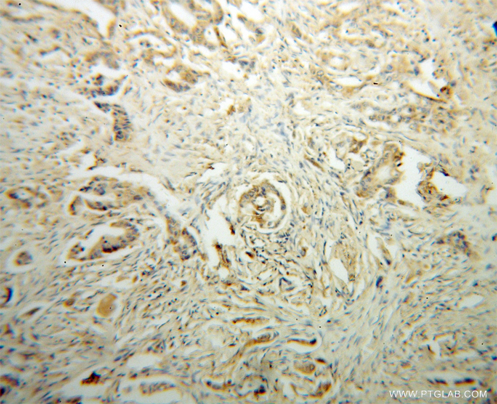 IHC staining of human colon cancer using 13900-1-AP