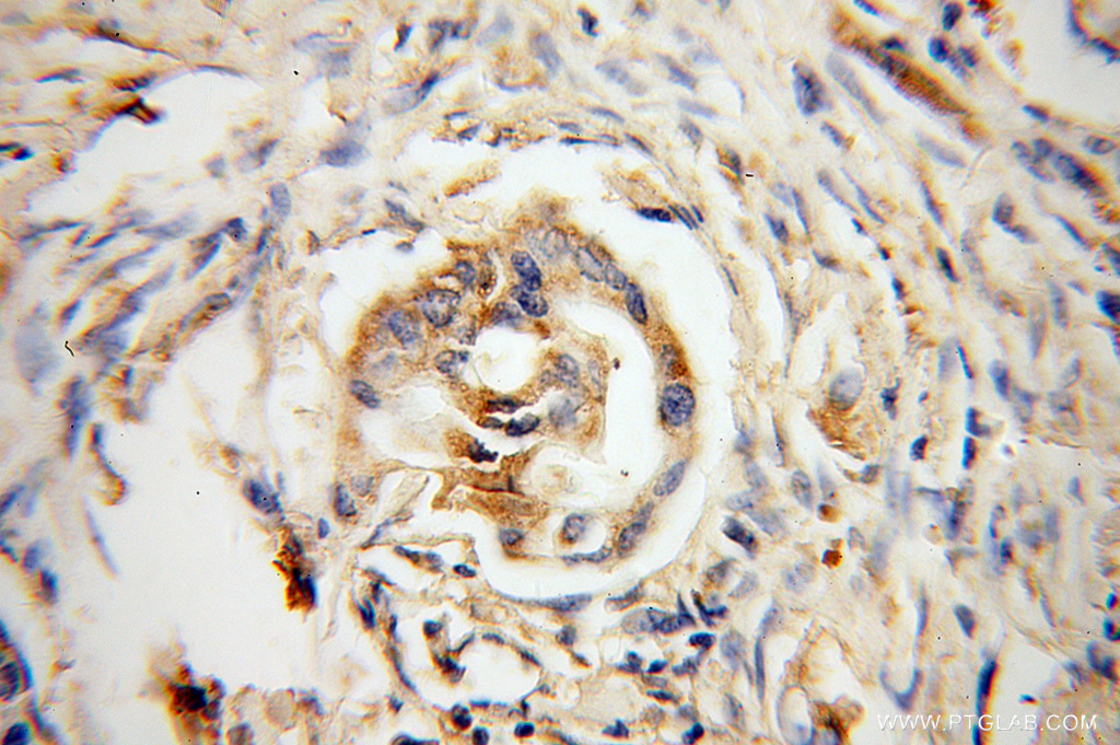 IHC staining of human colon cancer using 13900-1-AP