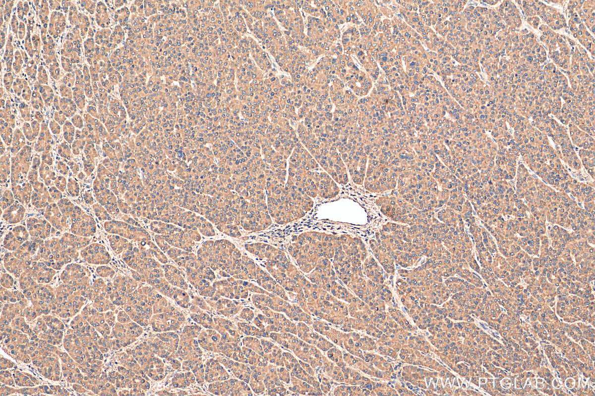 IHC staining of human liver cancer using 81021-1-RR (same clone as 81021-1-PBS)