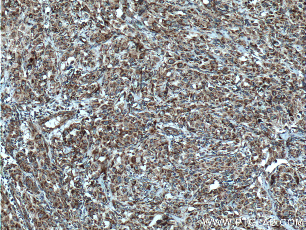 IHC staining of human cervical cancer using 15279-1-AP