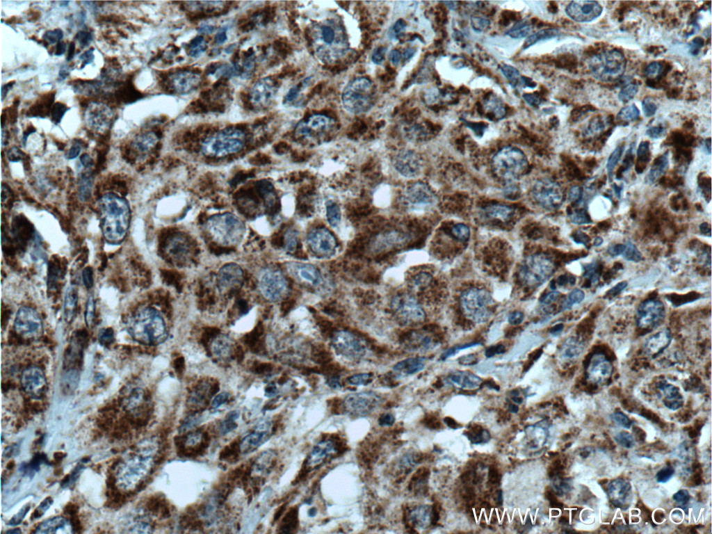 IHC staining of human cervical cancer using 15279-1-AP