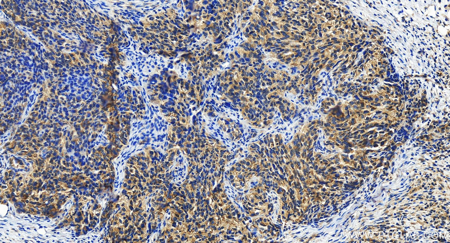 IHC staining of human ovary cancer using 13923-1-AP