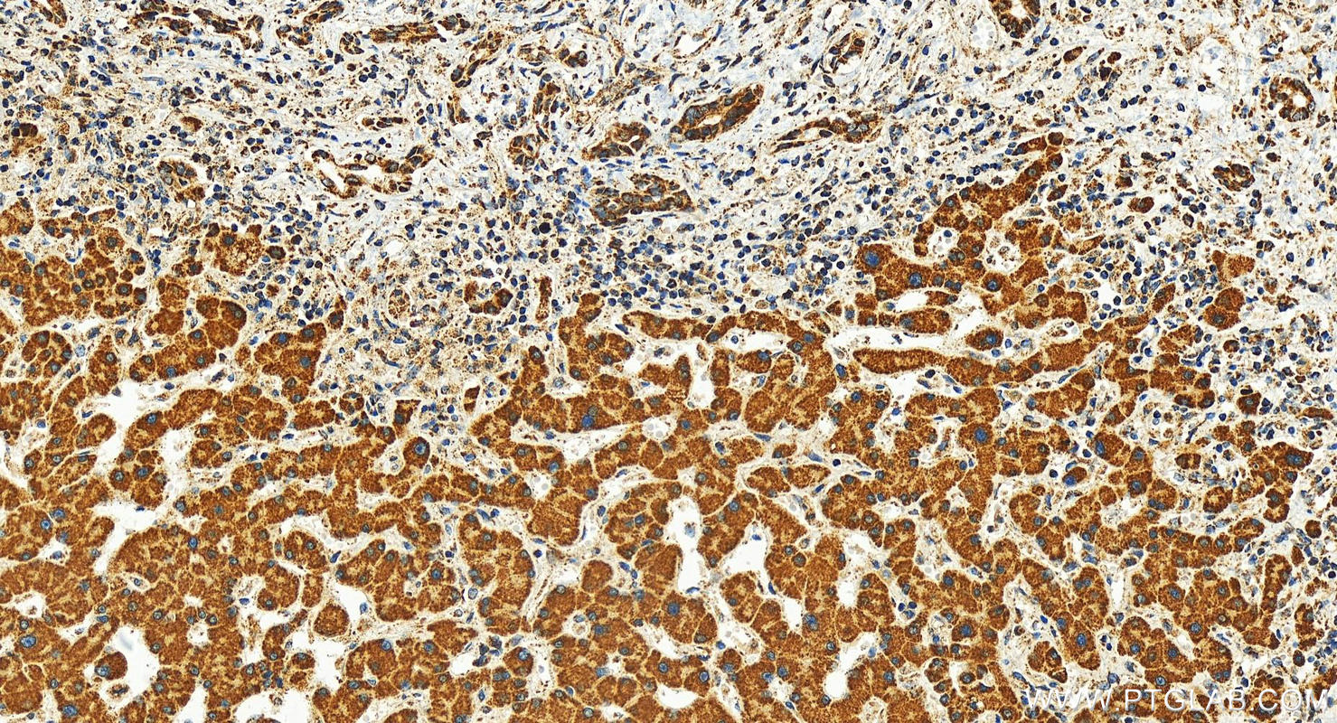 IHC staining of human intrahepatic cholangiocarcinoma using 29984-1-AP