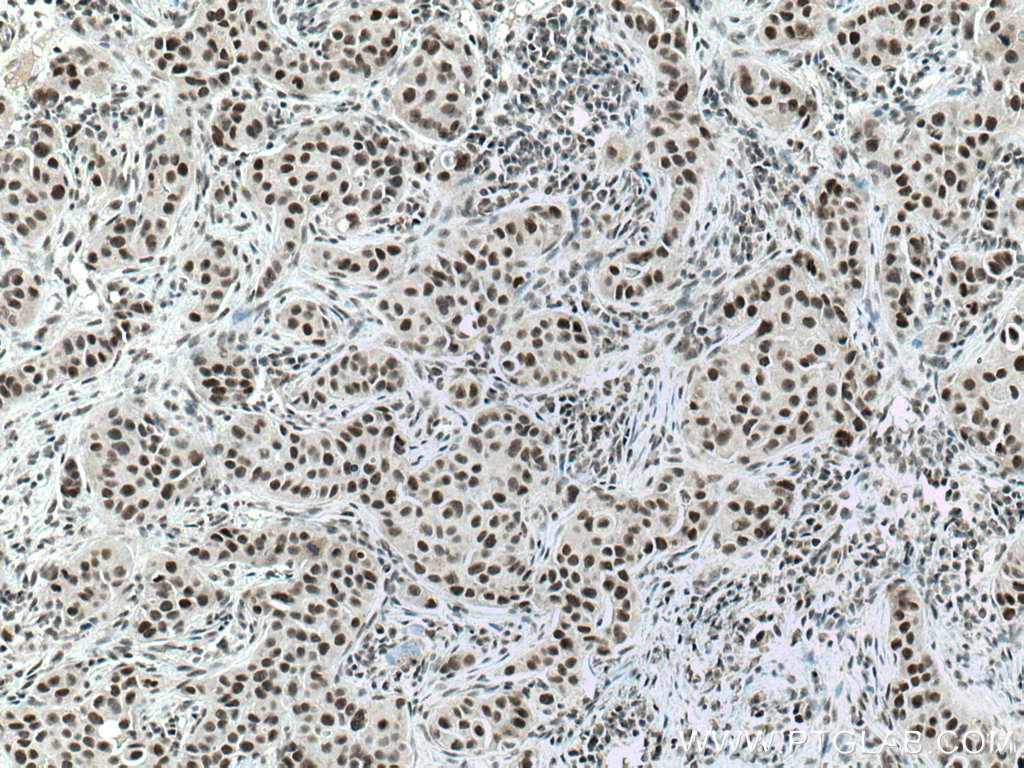 IHC staining of human breast cancer using 10183-1-AP