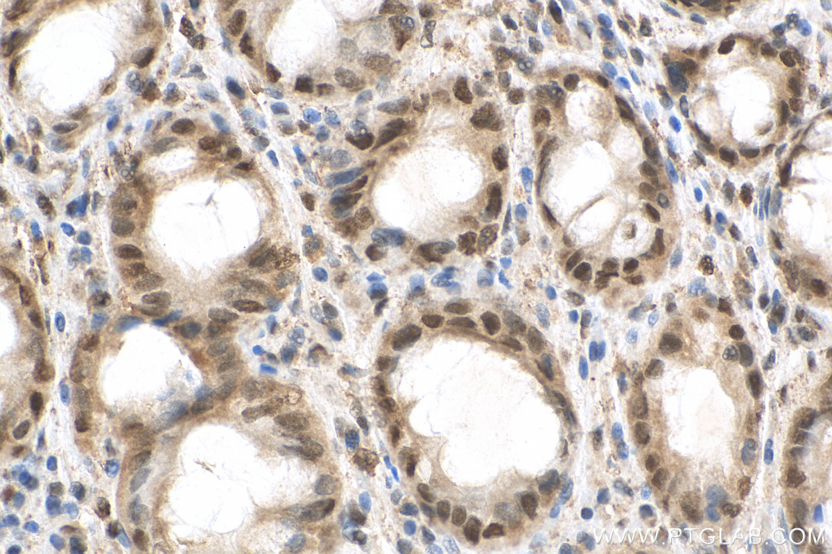 IHC staining of human colon cancer using 29664-1-AP