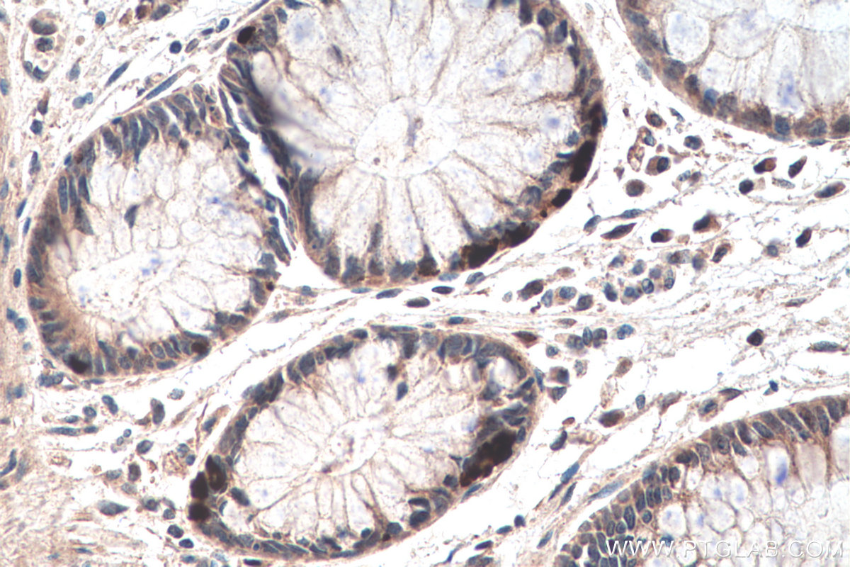 IHC staining of human colon cancer using 25420-1-AP