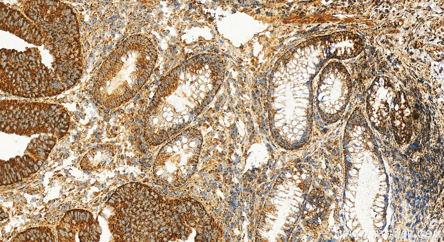 IHC staining of human colon cancer using 13426-1-AP