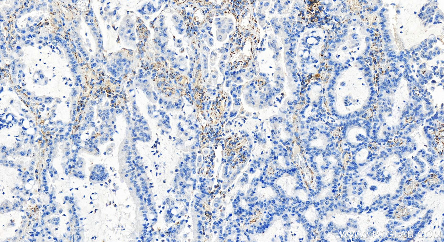 IHC staining of human stomach cancer using 83654-3-RR (same clone as 83654-3-PBS)