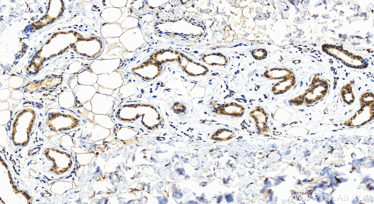 IHC staining of Human bowens disease using 15687-1-AP