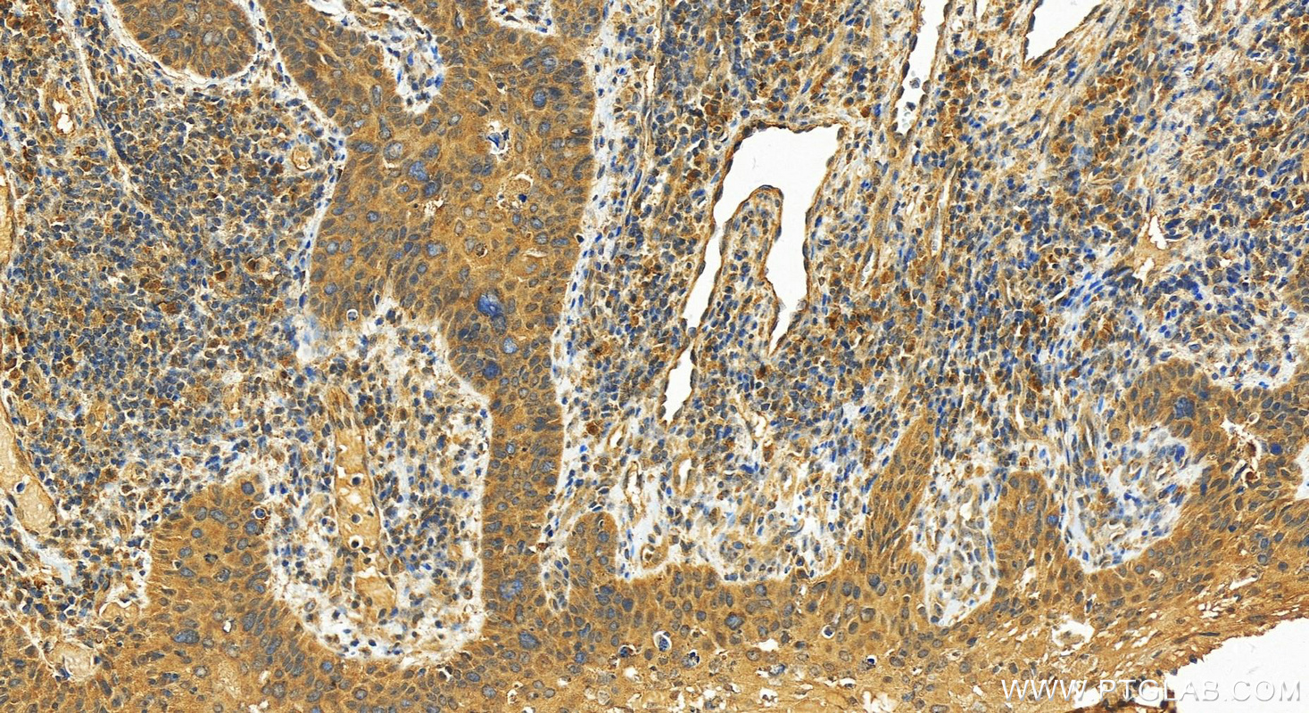 IHC staining of Human bowens disease using 15687-1-AP