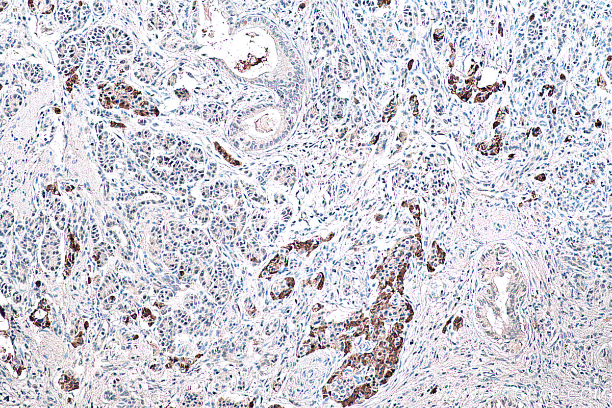 IHC staining of human pancreas cancer using 67923-1-Ig (same clone as 67923-1-PBS)