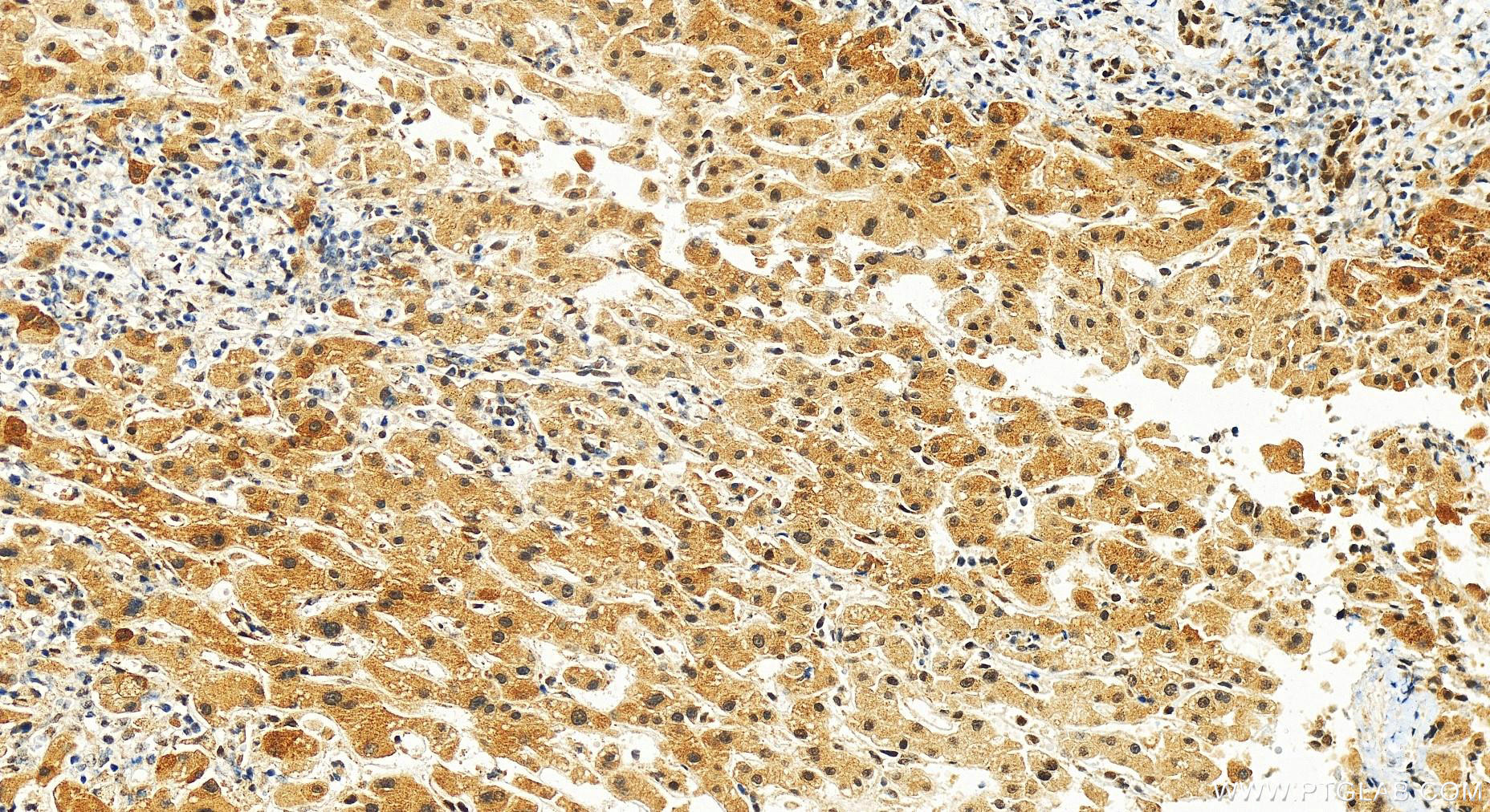 IHC staining of human intrahepatic cholangiocarcinoma using 10411-1-AP