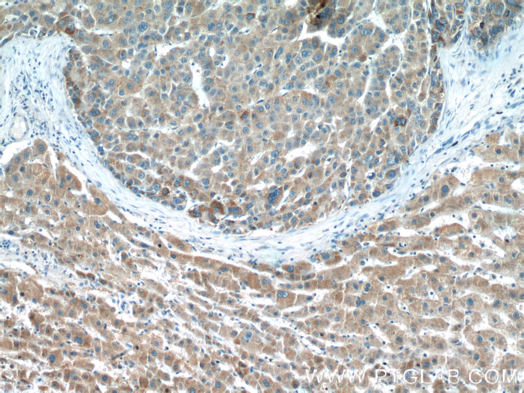 IHC staining of human liver cancer using 24813-1-AP (same clone as 24813-1-PBS)