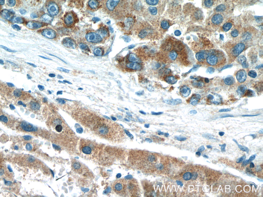 IHC staining of human liver cancer using 24813-1-AP (same clone as 24813-1-PBS)