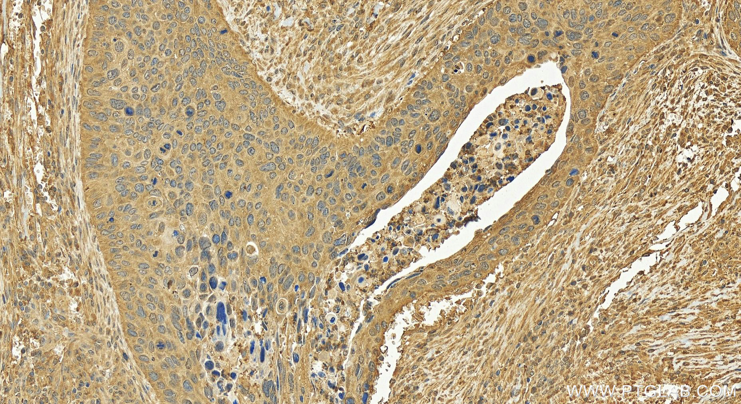 IHC staining of human cervical cancer using 18727-1-AP