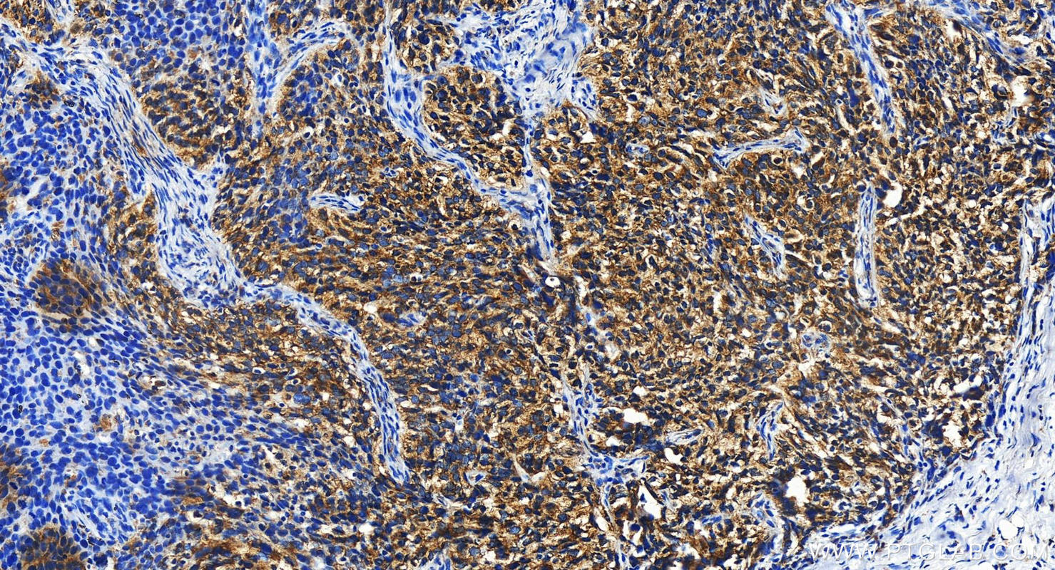 IHC staining of human ovary cancer using 16780-1-AP