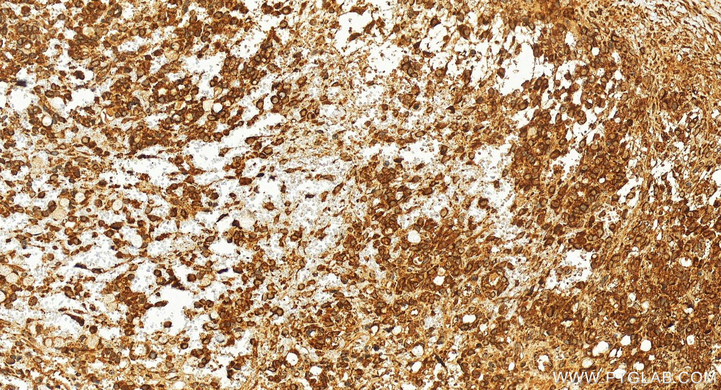 IHC staining of human ovary cancer using 16501-1-AP