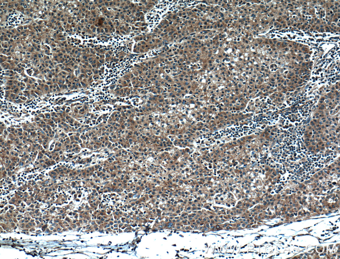 IHC staining of human liver cancer using 11971-1-AP