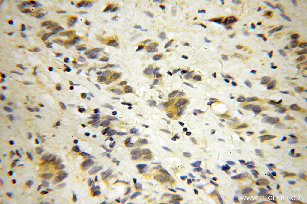 IHC staining of human gliomas using 14737-1-AP