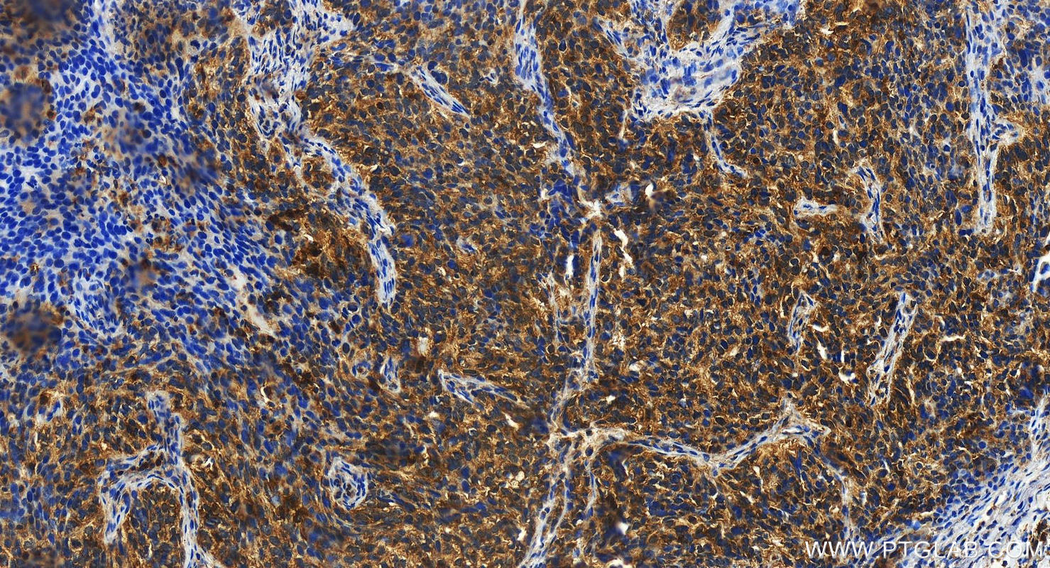 IHC staining of human ovary cancer using 17822-1-AP