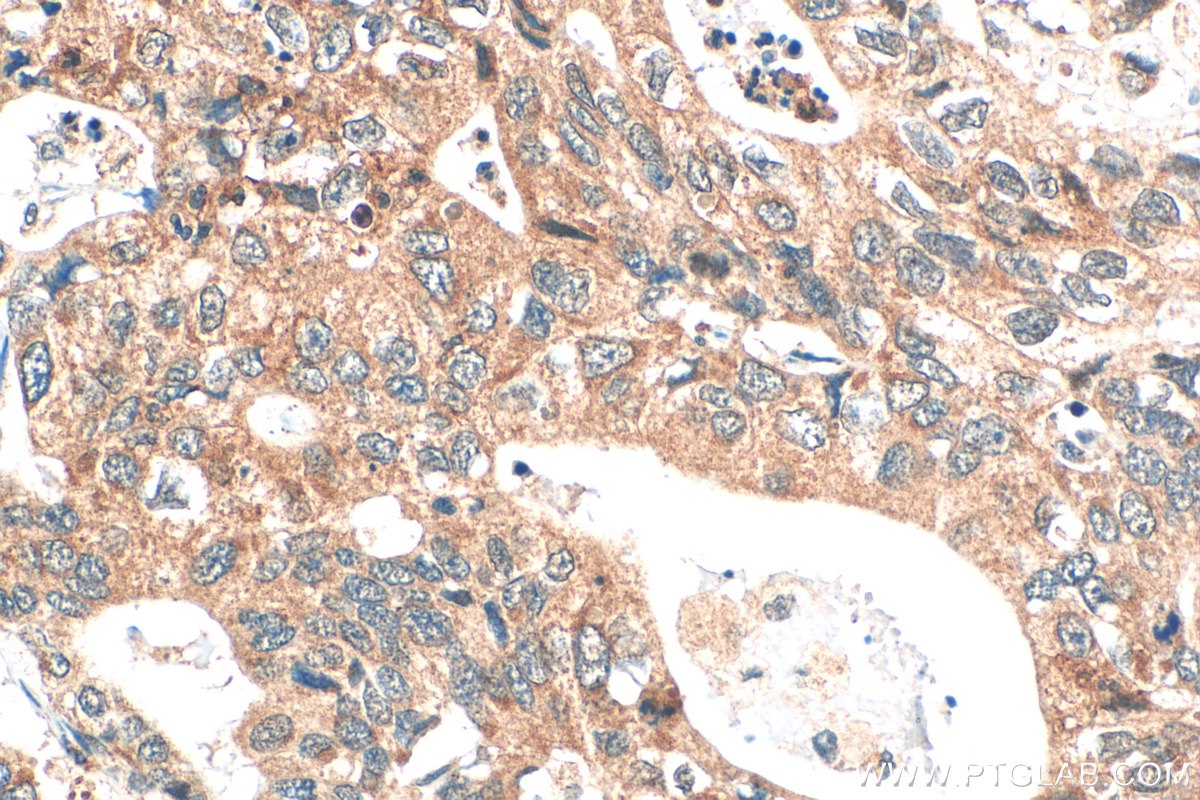 IHC staining of human stomach cancer using 31420-1-AP