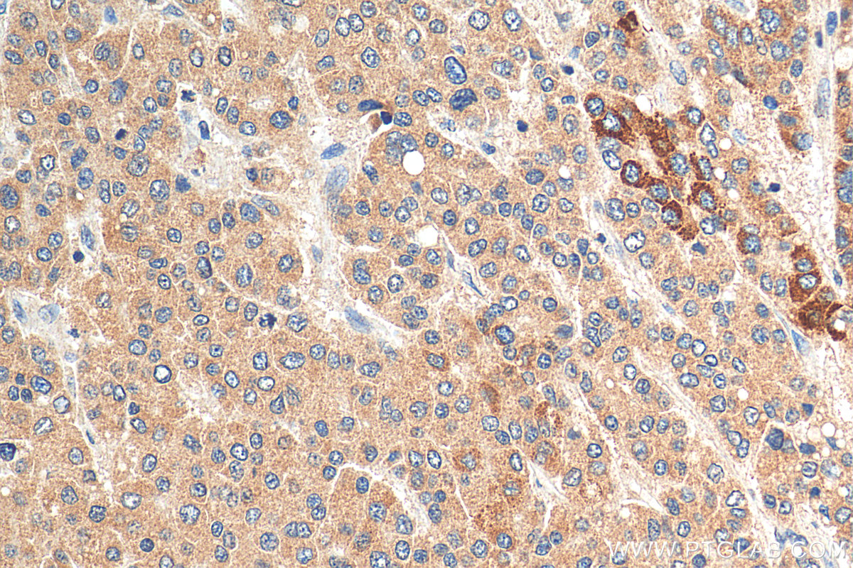 IHC staining of human liver cancer using 12403-2-AP